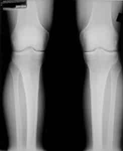 Kraakbeenherstel in rechter knie