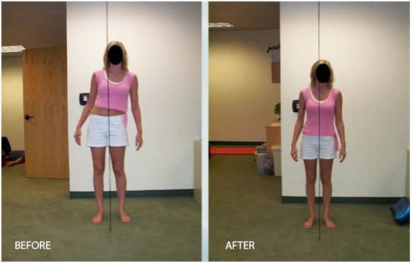 scoliosis-before-after